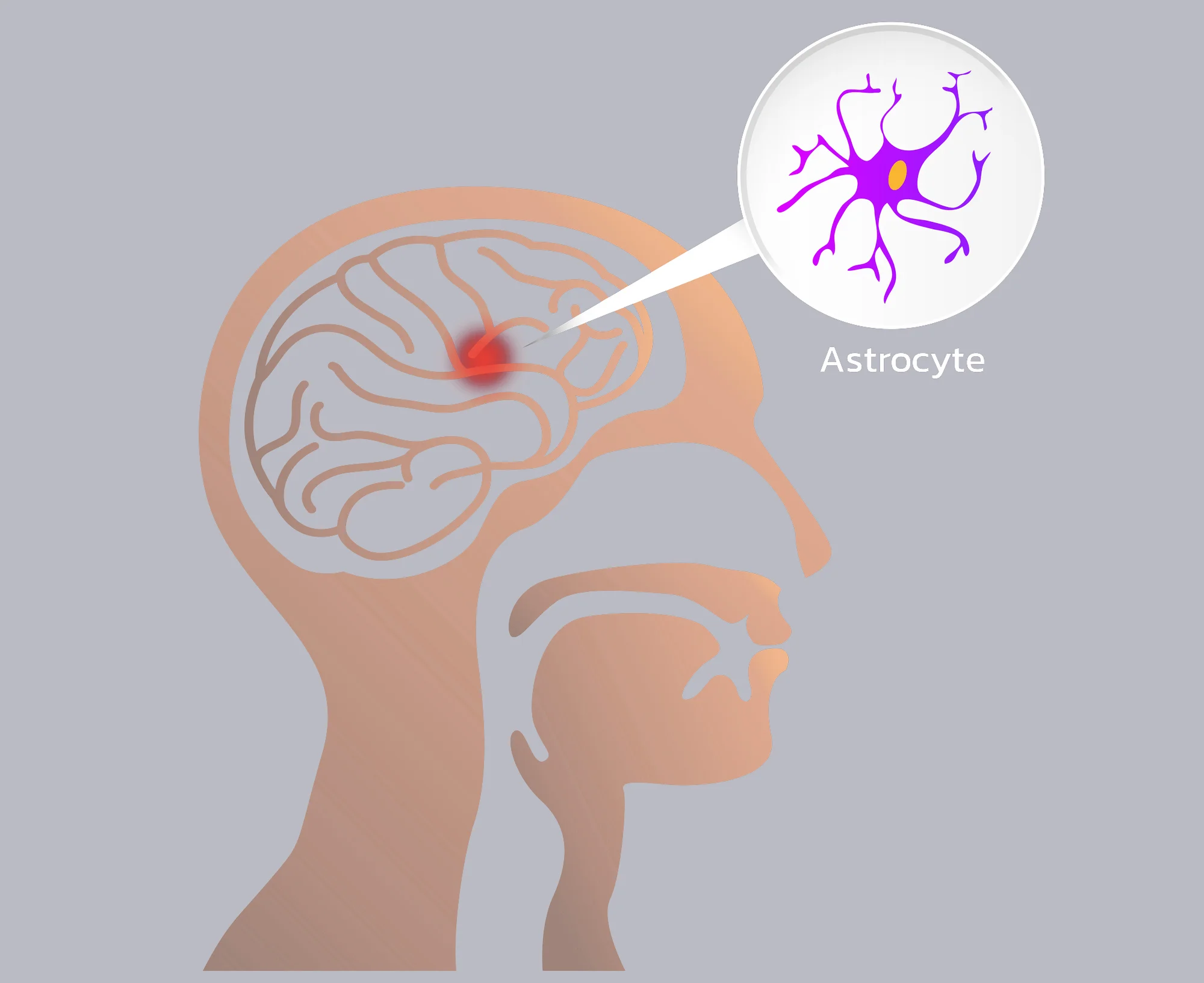 آستروسیتوم 